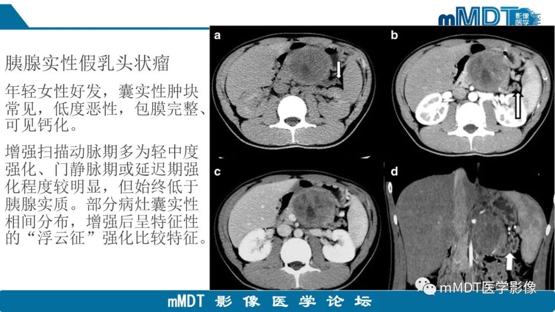 影像PPT - 【PPT】胰腺神经内分泌瘤分级影像对照及鉴别诊断-34 影像PPT - 【PPT】胰腺神经内分泌瘤分级影像对照及鉴别诊断-34