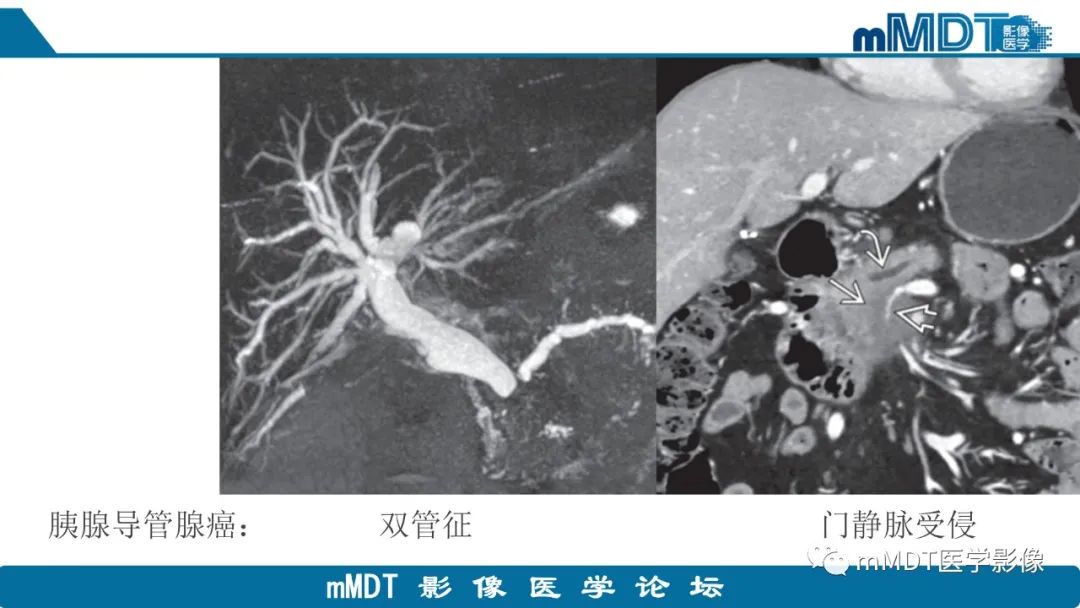 影像PPT - 【PPT】胰腺神经内分泌瘤分级影像对照及鉴别诊断-37 影像PPT - 【PPT】胰腺神经内分泌瘤分级影像对照及鉴别诊断-37