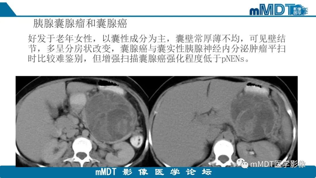 影像PPT - 【PPT】胰腺神经内分泌瘤分级影像对照及鉴别诊断-35 影像PPT - 【PPT】胰腺神经内分泌瘤分级影像对照及鉴别诊断-35