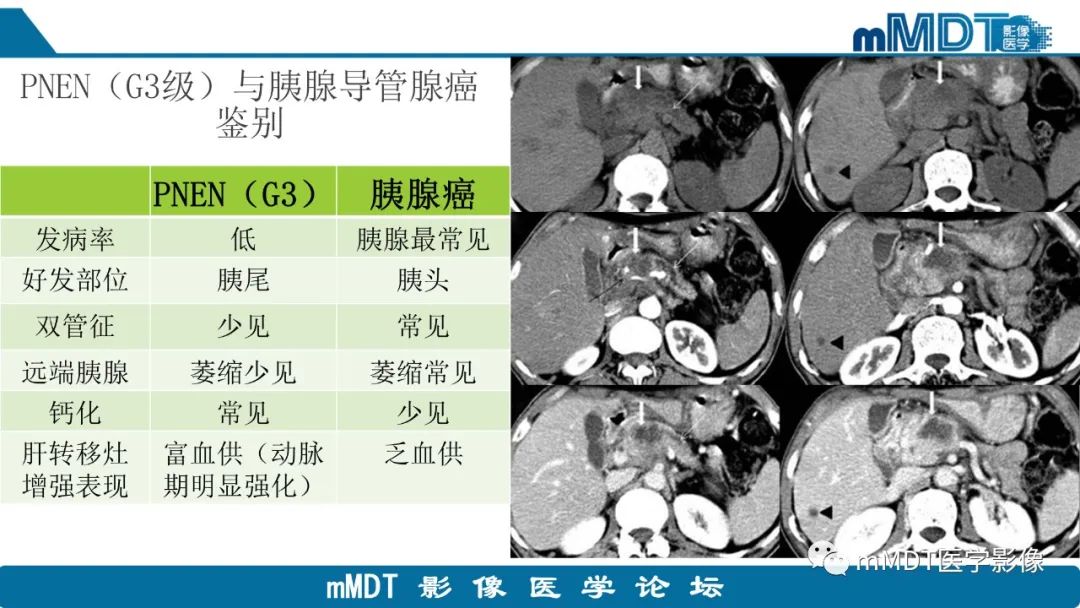 影像PPT - 【PPT】胰腺神经内分泌瘤分级影像对照及鉴别诊断-36 影像PPT - 【PPT】胰腺神经内分泌瘤分级影像对照及鉴别诊断-36