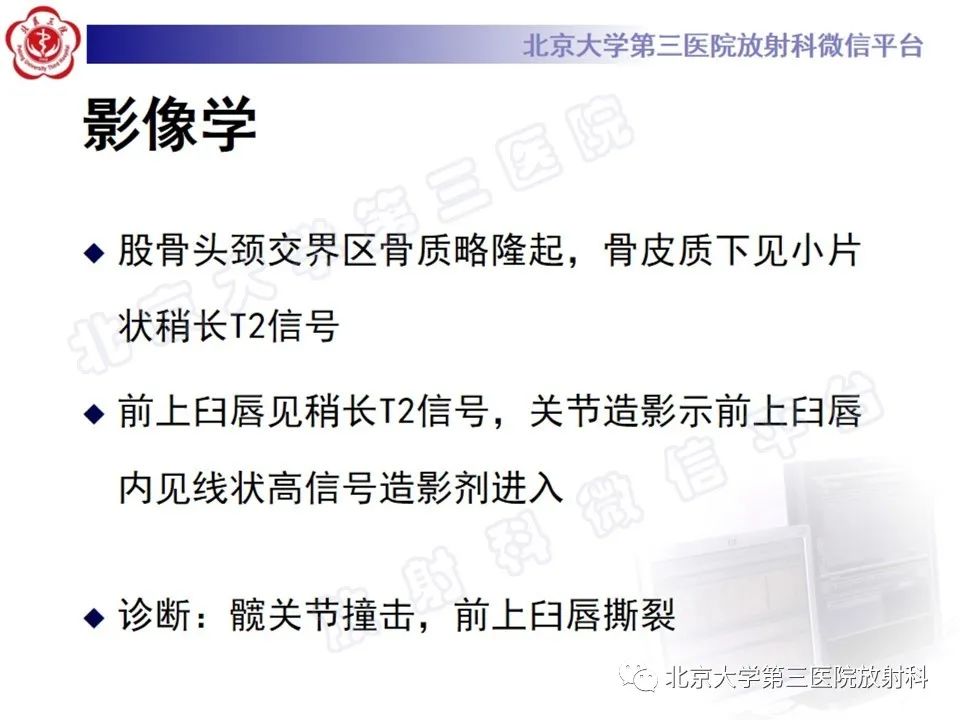 影像PPT - 【PPT】髋臼唇撕裂-5