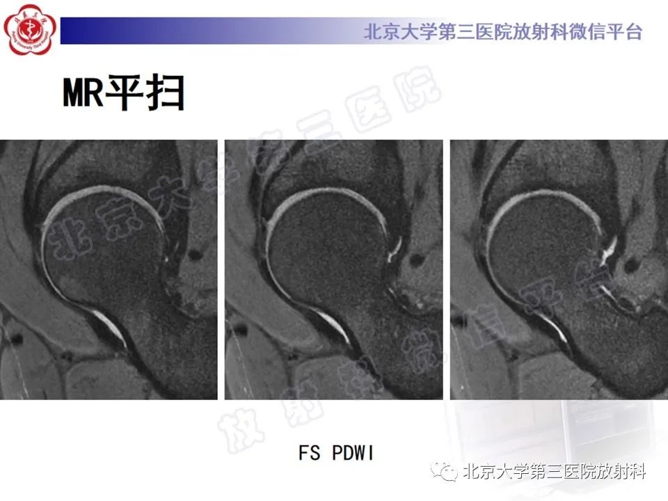 影像PPT - 【PPT】髋臼唇撕裂-3