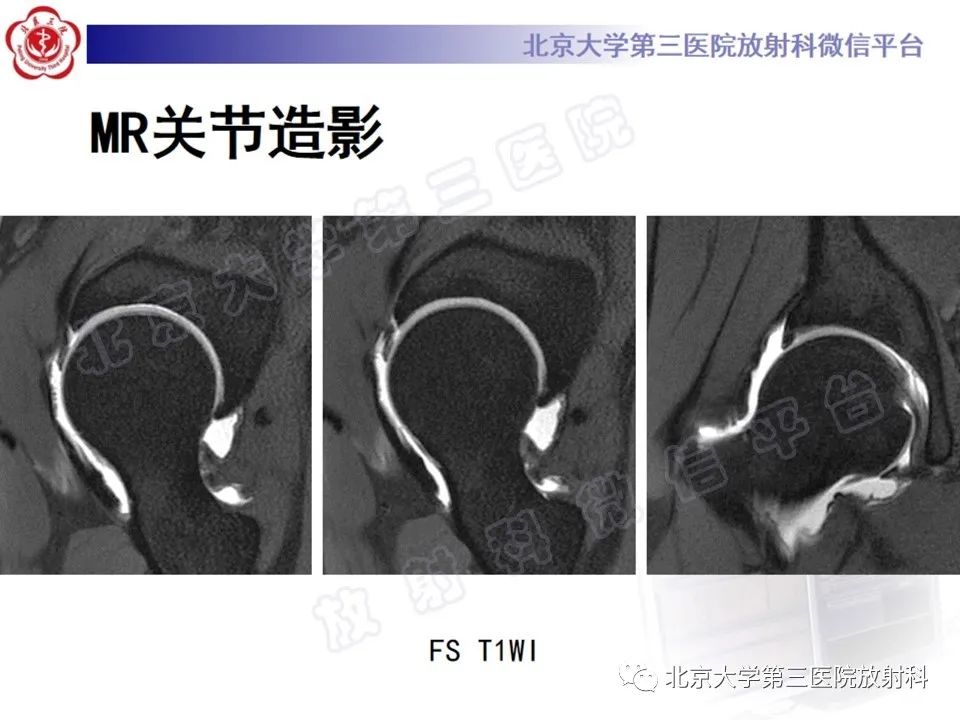 影像PPT - 【PPT】髋臼唇撕裂-4