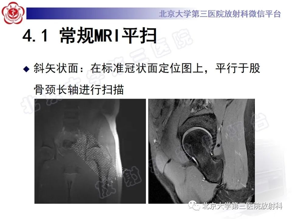 影像PPT - 【PPT】髋臼唇撕裂-15