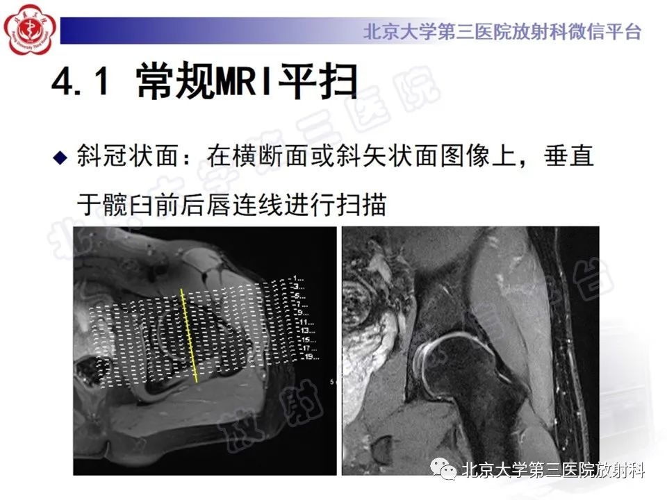 影像PPT - 【PPT】髋臼唇撕裂-16