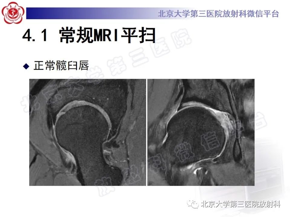 影像PPT - 【PPT】髋臼唇撕裂-18