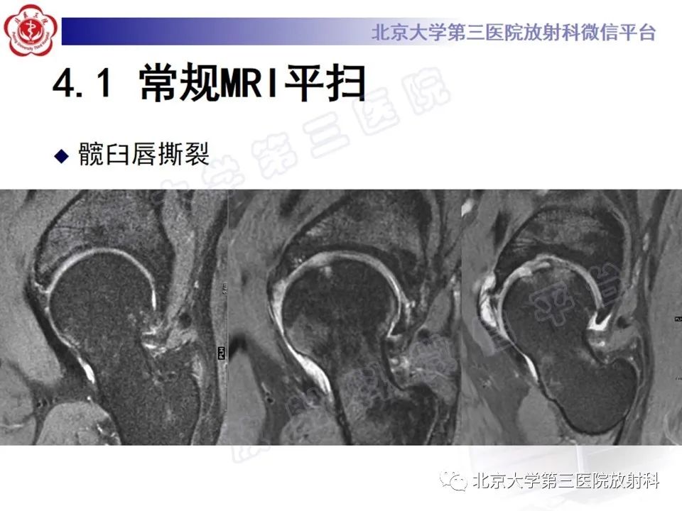 影像PPT - 【PPT】髋臼唇撕裂-19