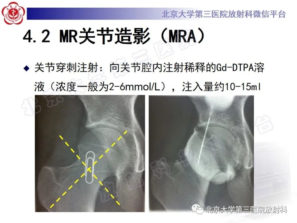 影像PPT - 【PPT】髋臼唇撕裂-21