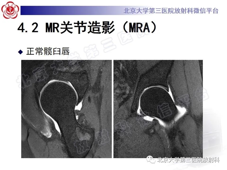 影像PPT - 【PPT】髋臼唇撕裂-24