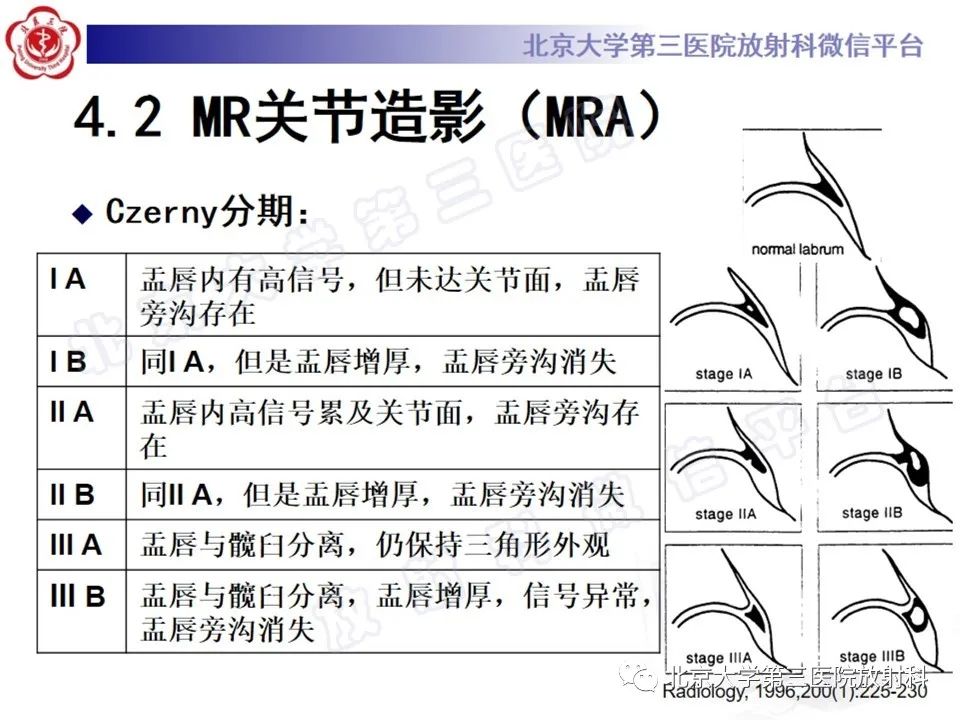影像PPT - 【PPT】髋臼唇撕裂-23