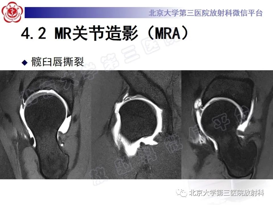 影像PPT - 【PPT】髋臼唇撕裂-25