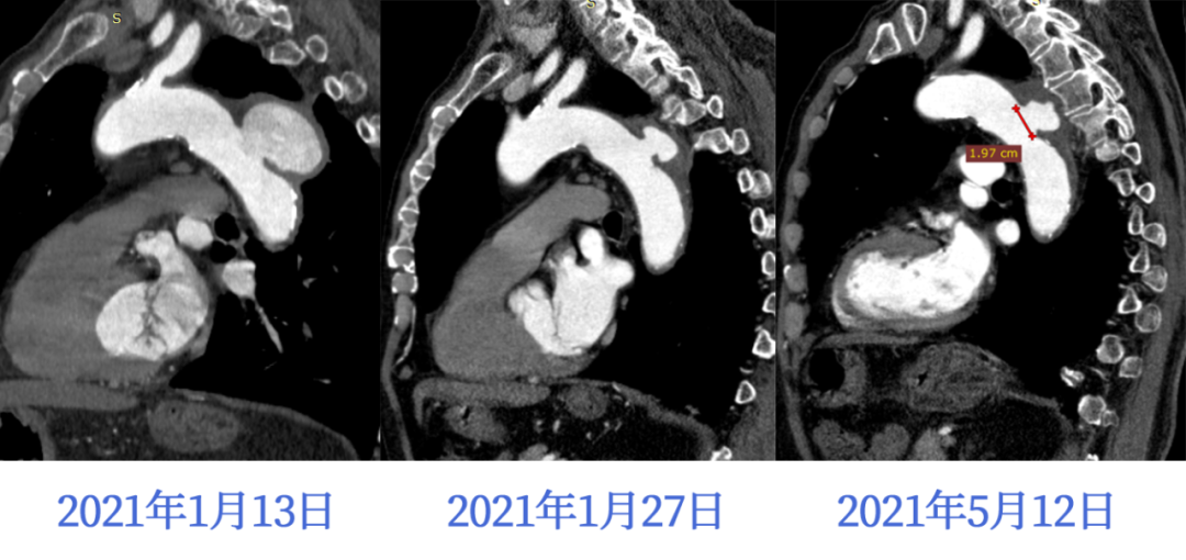 影像PPT - 【病例】颤抖吧,沙门瘤君!—感染性主动脉瘤1例CT影像-15 影像PPT - 【病例】颤抖吧,沙门瘤君!—感染性主动脉瘤1例CT影像-15