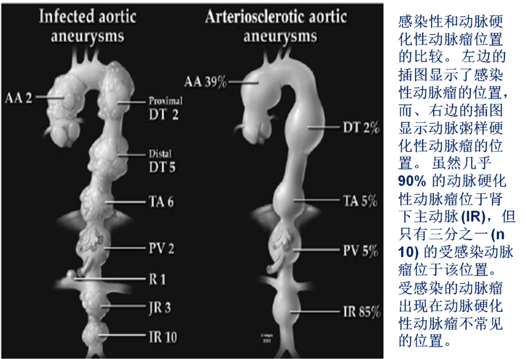影像PPT - 【病例】颤抖吧,沙门瘤君!—感染性主动脉瘤1例CT影像-18 影像PPT - 【病例】颤抖吧,沙门瘤君!—感染性主动脉瘤1例CT影像-18