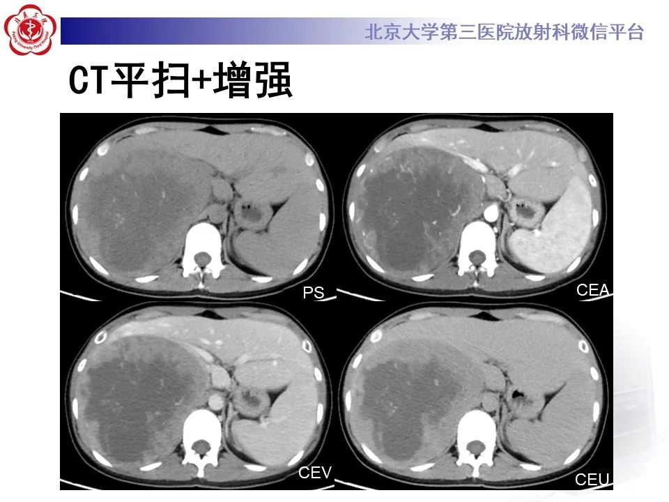 影像PPT - 【PPT】肾上腺原始神经外胚层肿瘤-3