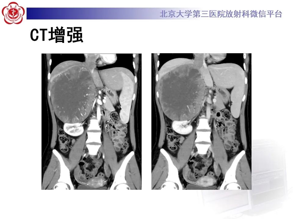 影像PPT - 【PPT】肾上腺原始神经外胚层肿瘤-4