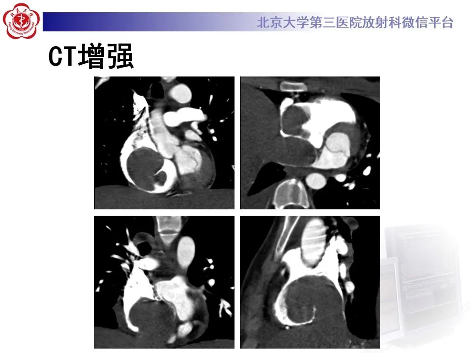影像PPT - 【PPT】肾上腺原始神经外胚层肿瘤-5