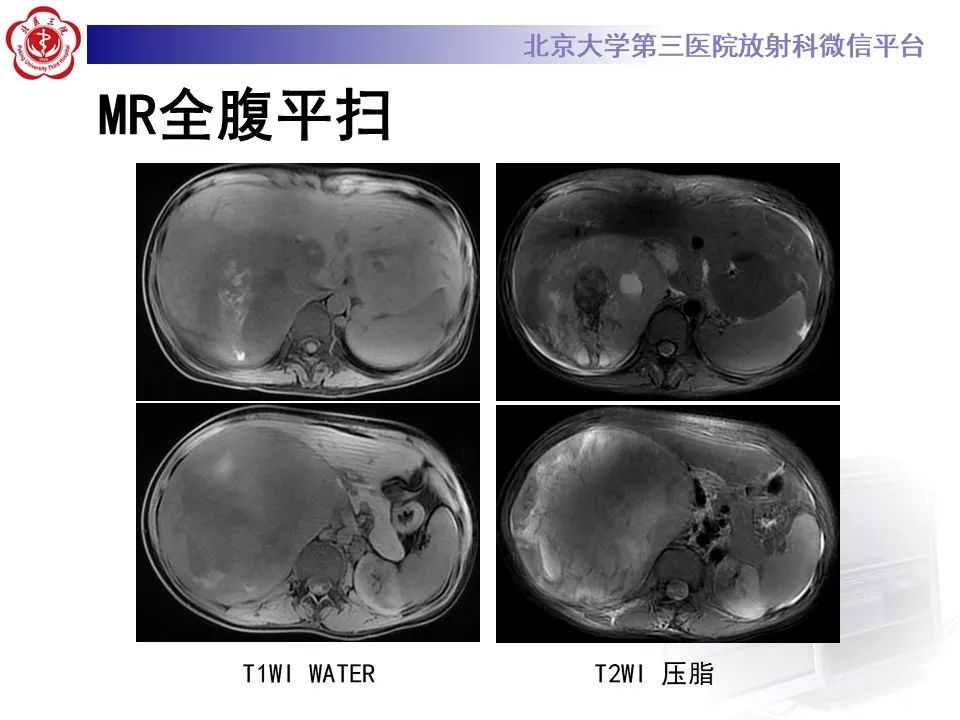 影像PPT - 【PPT】肾上腺原始神经外胚层肿瘤-6