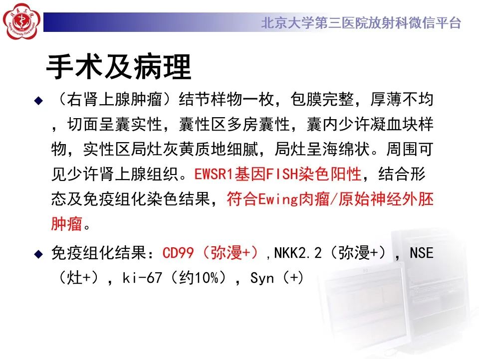 影像PPT - 【PPT】肾上腺原始神经外胚层肿瘤-11