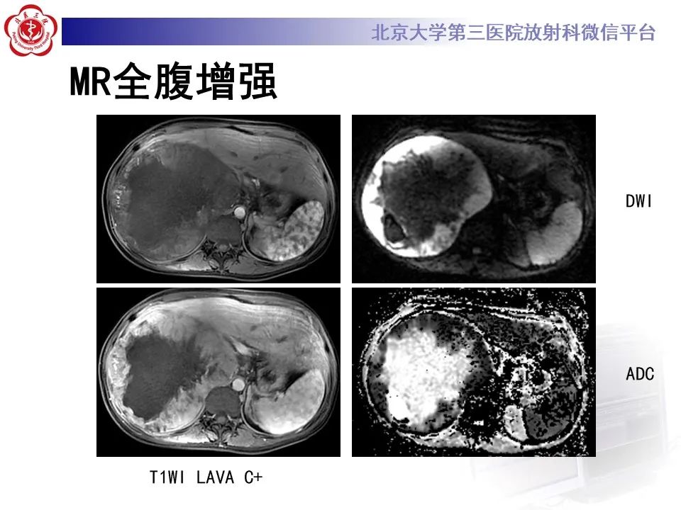 影像PPT - 【PPT】肾上腺原始神经外胚层肿瘤-7