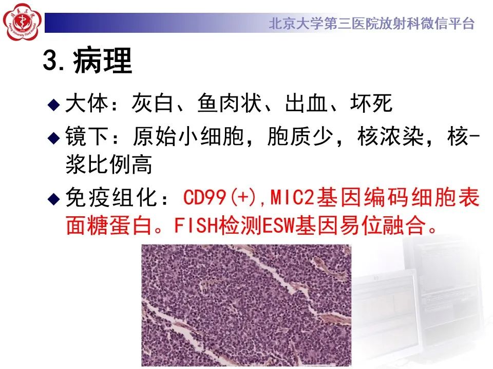 影像PPT - 【PPT】肾上腺原始神经外胚层肿瘤-15