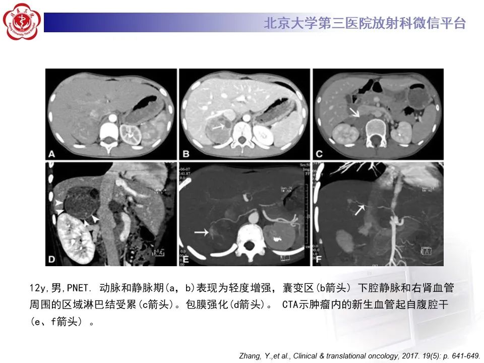 影像PPT - 【PPT】肾上腺原始神经外胚层肿瘤-17