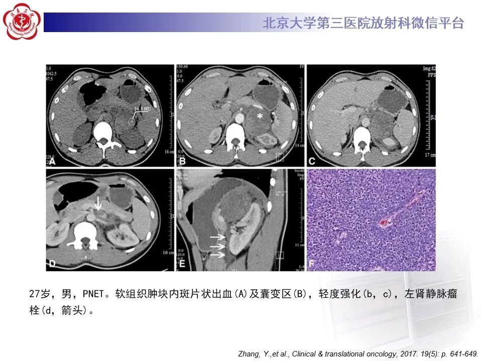 影像PPT - 【PPT】肾上腺原始神经外胚层肿瘤-18