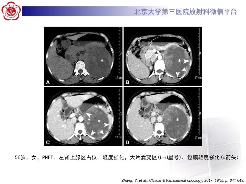 影像PPT - 【PPT】肾上腺原始神经外胚层肿瘤-19
