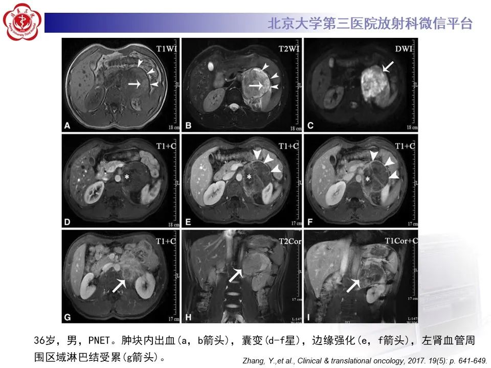 影像PPT - 【PPT】肾上腺原始神经外胚层肿瘤-20