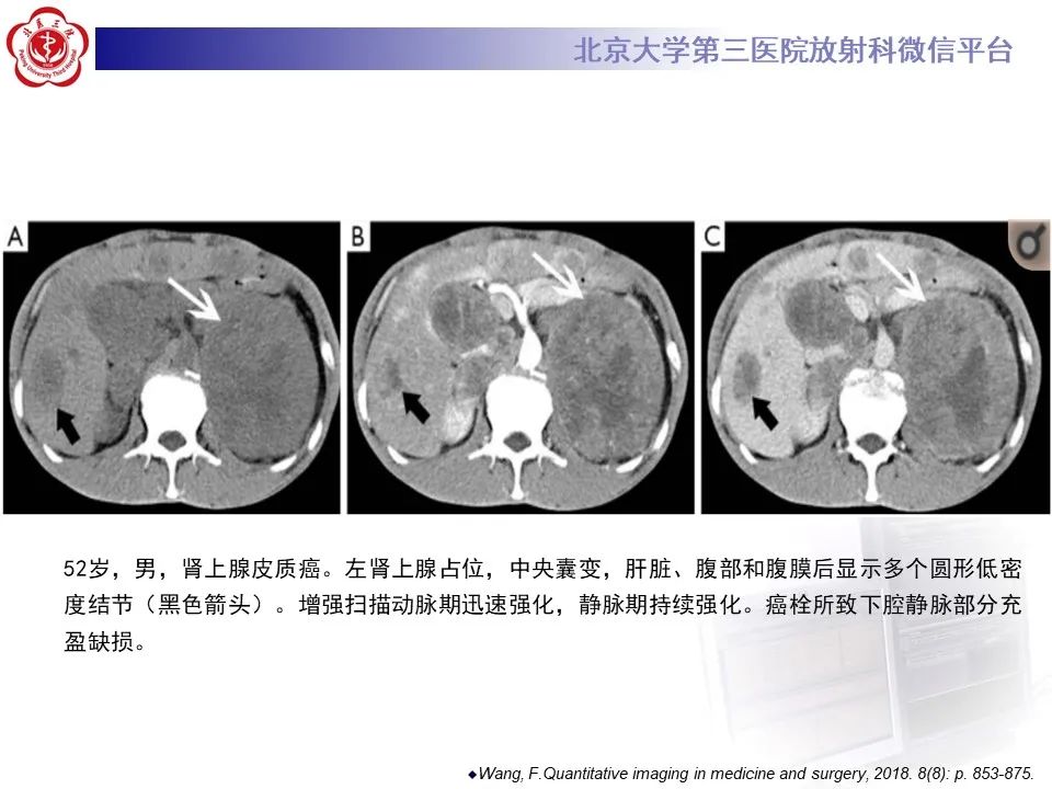 影像PPT - 【PPT】肾上腺原始神经外胚层肿瘤-23