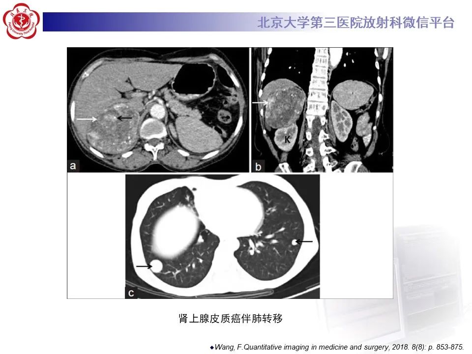 影像PPT - 【PPT】肾上腺原始神经外胚层肿瘤-24