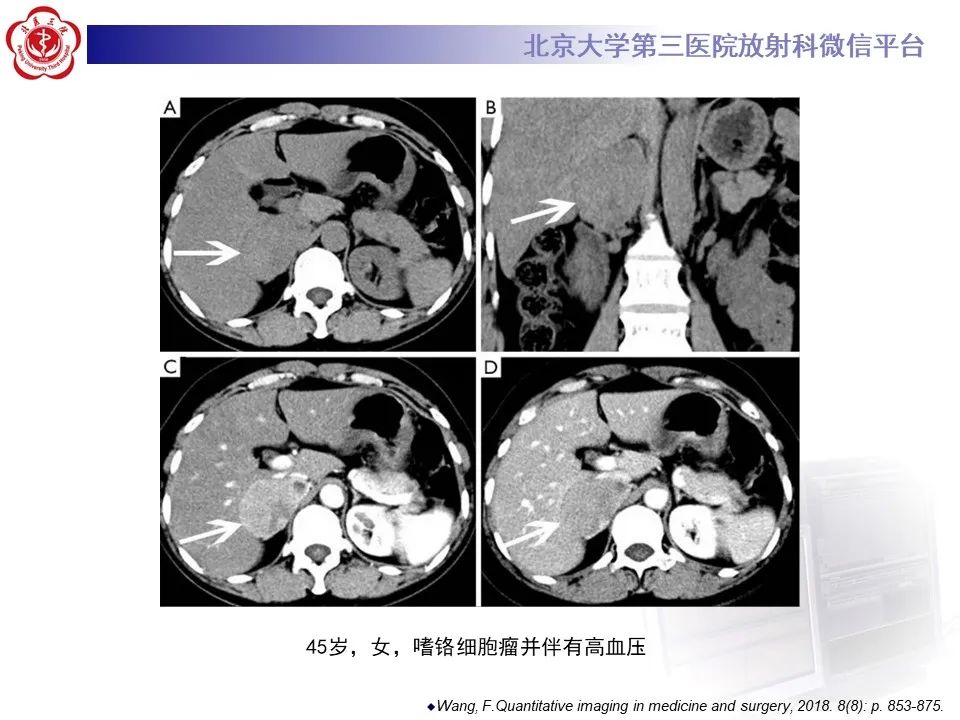影像PPT - 【PPT】肾上腺原始神经外胚层肿瘤-26