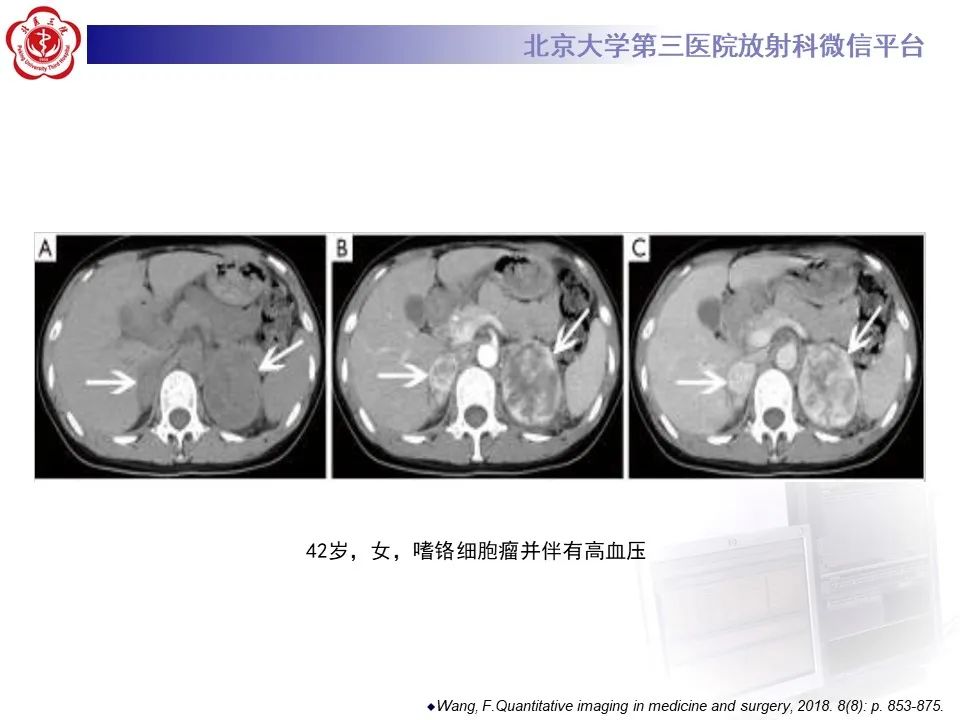 影像PPT - 【PPT】肾上腺原始神经外胚层肿瘤-27