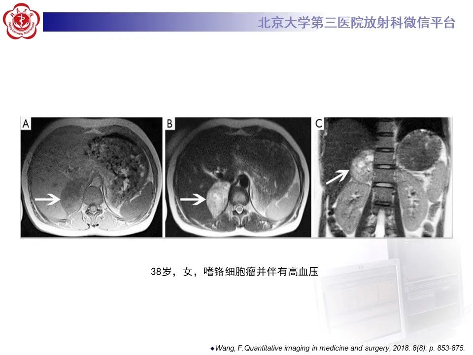 影像PPT - 【PPT】肾上腺原始神经外胚层肿瘤-28