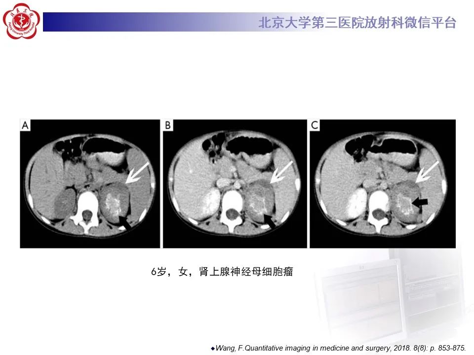 影像PPT - 【PPT】肾上腺原始神经外胚层肿瘤-30