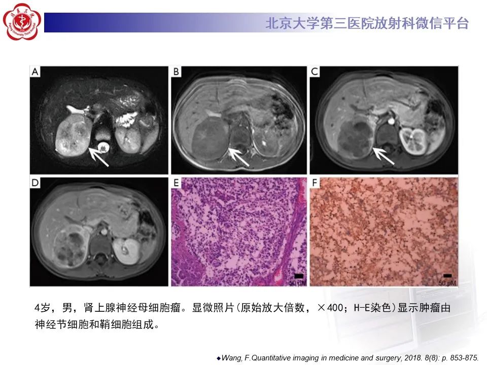 影像PPT - 【PPT】肾上腺原始神经外胚层肿瘤-31