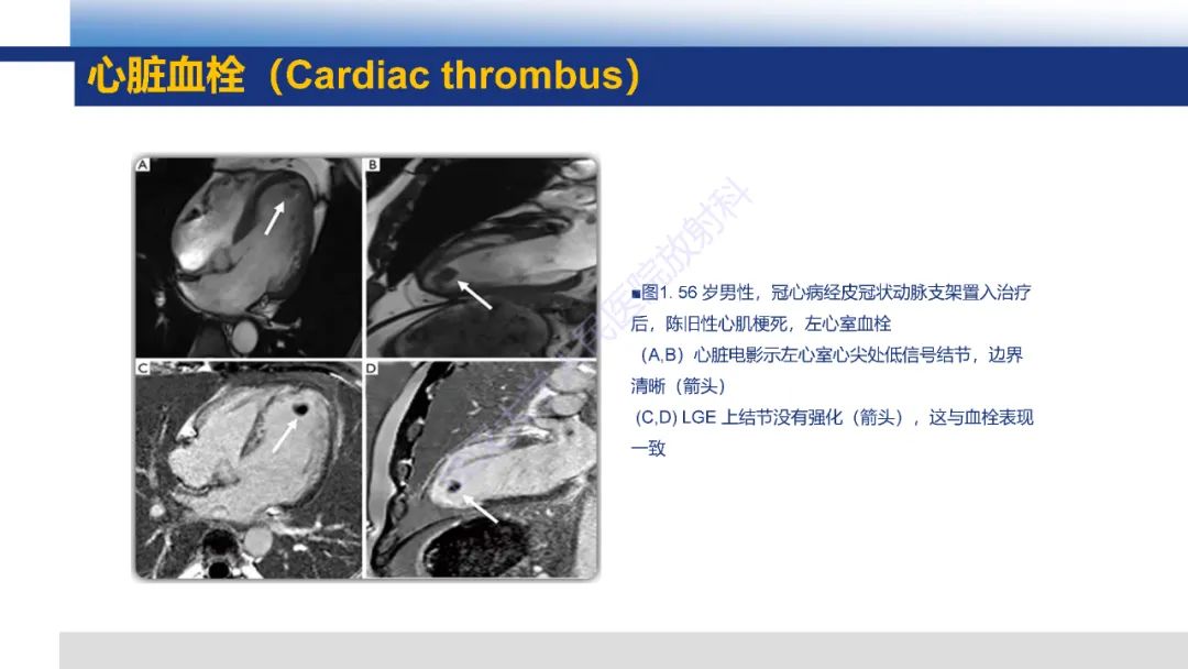 影像PPT - 【PPT】心脏原发肿瘤MR诊断-8