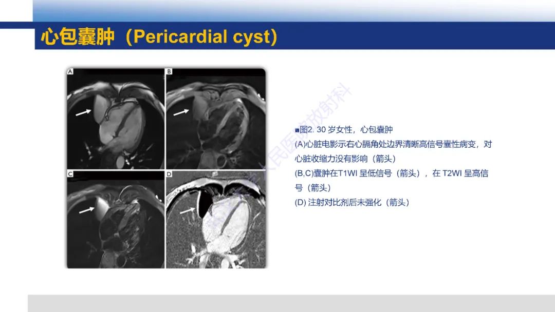 影像PPT - 【PPT】心脏原发肿瘤MR诊断-10