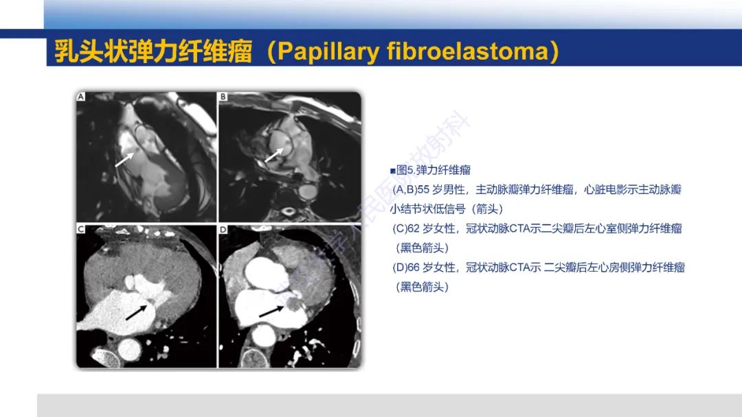 影像PPT - 【PPT】心脏原发肿瘤MR诊断-18