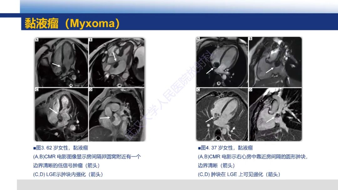 影像PPT - 【PPT】心脏原发肿瘤MR诊断-15