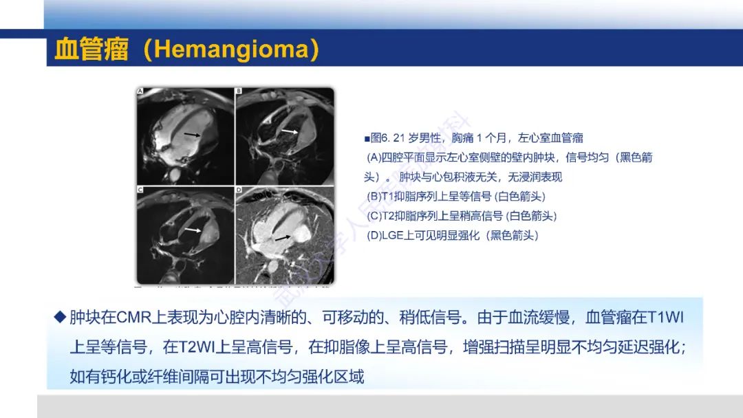 影像PPT - 【PPT】心脏原发肿瘤MR诊断-21