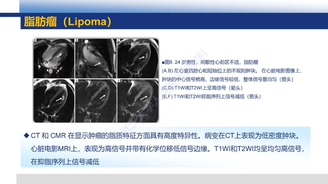 影像PPT - 【PPT】心脏原发肿瘤MR诊断-25