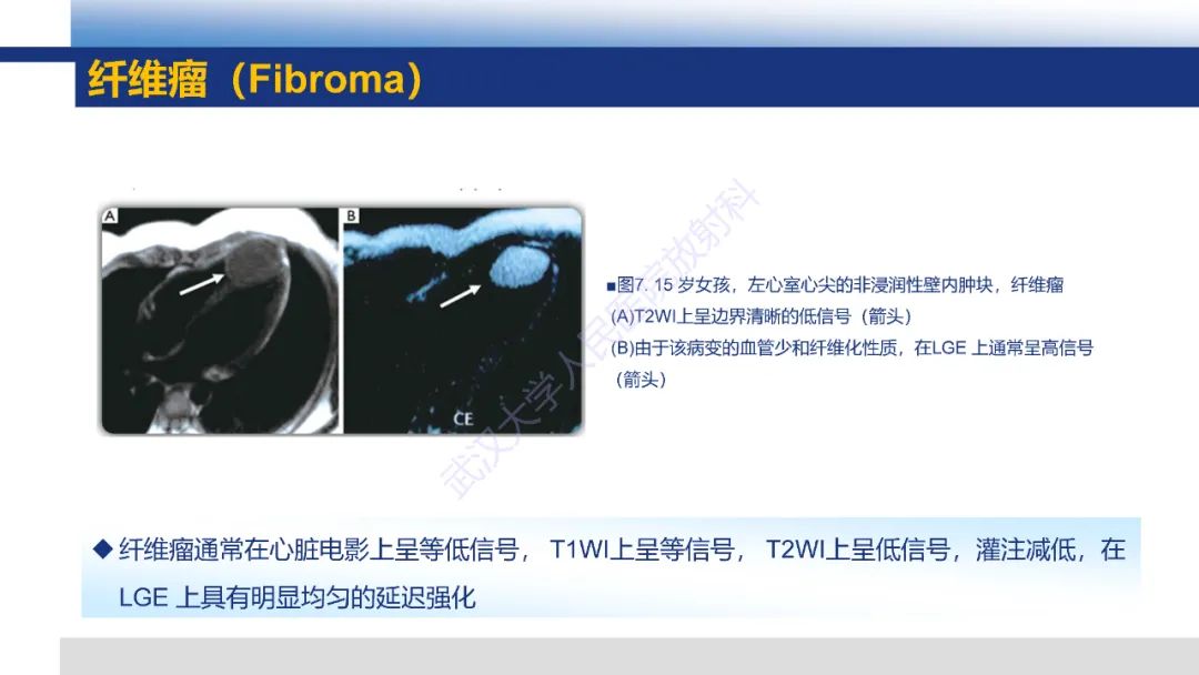 影像PPT - 【PPT】心脏原发肿瘤MR诊断-23