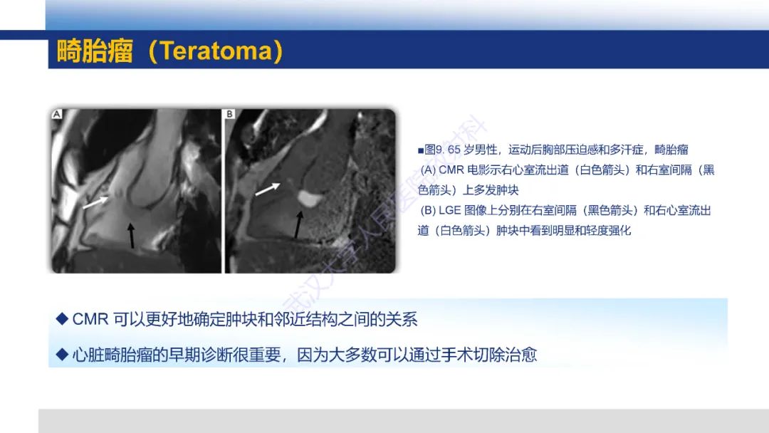 影像PPT - 【PPT】心脏原发肿瘤MR诊断-27