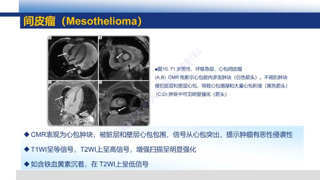 影像PPT - 【PPT】心脏原发肿瘤MR诊断-32