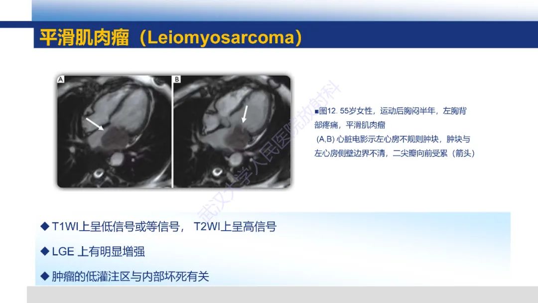 影像PPT - 【PPT】心脏原发肿瘤MR诊断-36