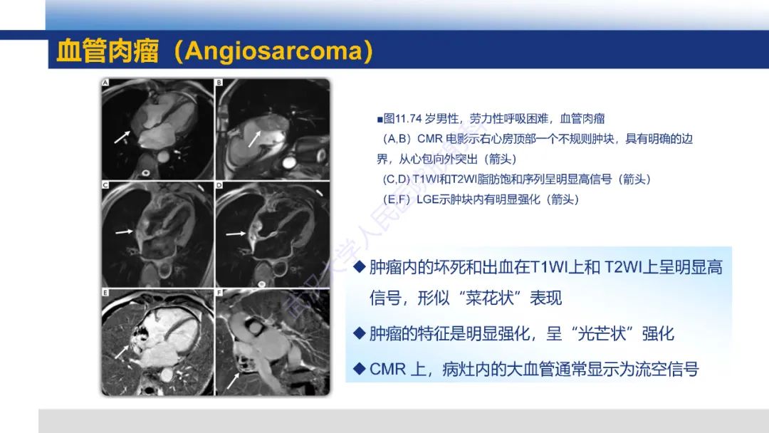 影像PPT - 【PPT】心脏原发肿瘤MR诊断-34
