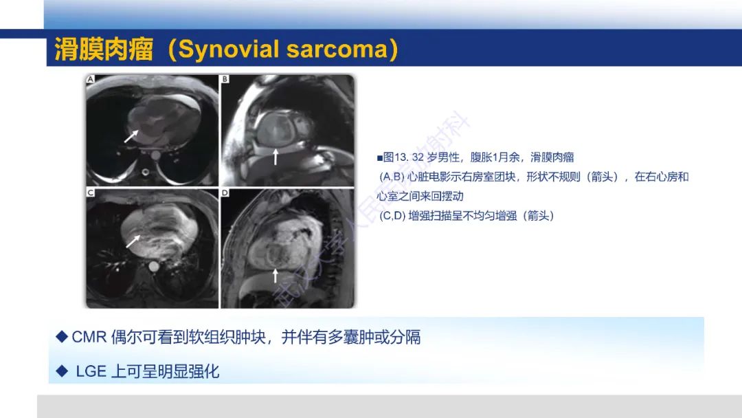 影像PPT - 【PPT】心脏原发肿瘤MR诊断-38