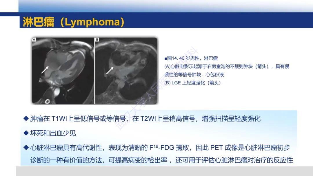影像PPT - 【PPT】心脏原发肿瘤MR诊断-40