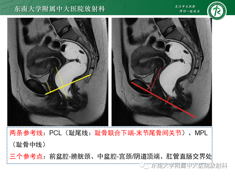 影像PPT - 【PPT】盆腔脏器脱垂—MR影像-2