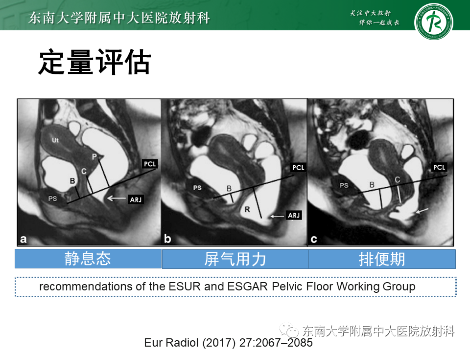 影像PPT - 【PPT】盆腔脏器脱垂—MR影像-14